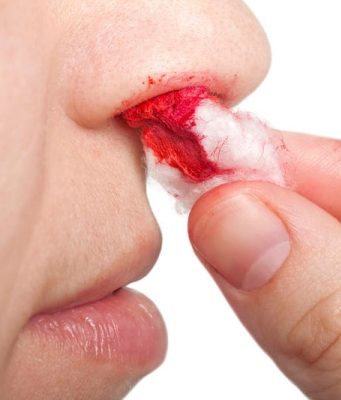 Почему из носа идёт кровь? Как её правильно остановить: рекомендации врачей