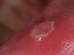 Как лечить стоматит? Эффективные советы врачей