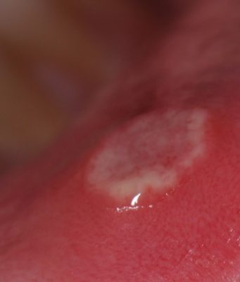 Как лечить стоматит? Эффективные советы врачей