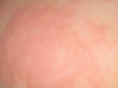 Какие симптомы у взрослых и детей при крапивнице?