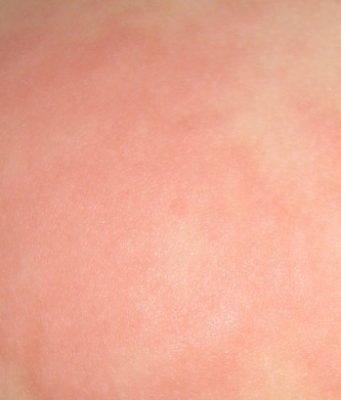 Какие симптомы у взрослых и детей при крапивнице?