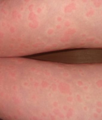 Перечень причин крапивницы и первые действия при ней. Советы от профессионалов