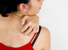 Как вылечить крапивницу у взрослых в домашних условиях