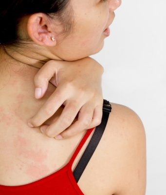 Как вылечить крапивницу у взрослых в домашних условиях