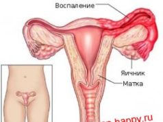воспаление придатков симптомы и лечение