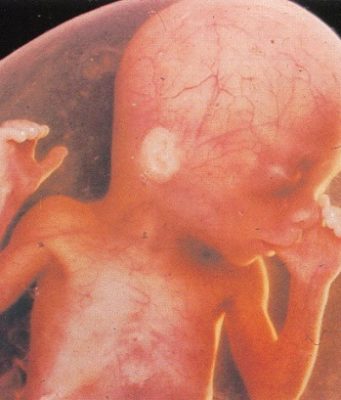 Выкидыш: признаки, причины и профилактика