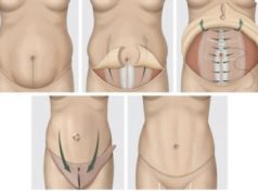 Абдоминопластика — гарантия результата