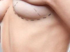 Немного о подтяжке груди