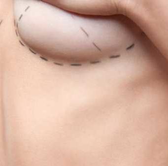 Немного о подтяжке груди