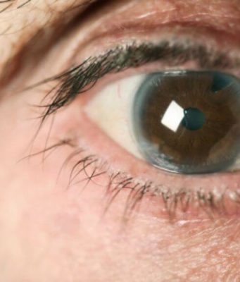 Способы лечения узкоугольной глаукомы