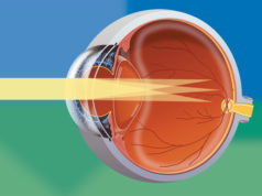 Современные методы лечения астигматизма