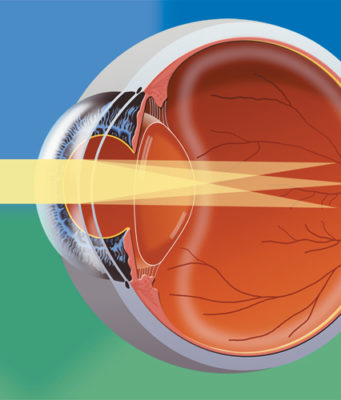 Современные методы лечения астигматизма