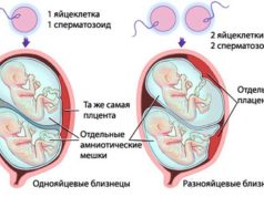 Особенности многоплодной беременности