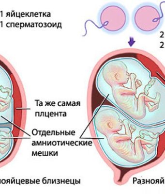 Особенности многоплодной беременности