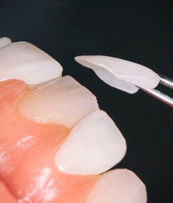 Виниры: секрет голливудской улыбки