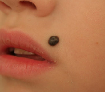 Удаление новообразований