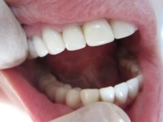 Преимущества безметалловой коронки E Max