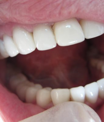 Преимущества безметалловой коронки E Max