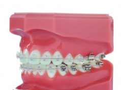 Особенности керамических брекетов