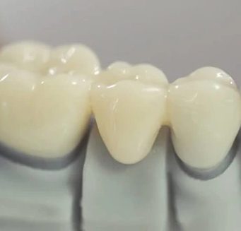 Несъемный зубной протез — виды и особенности