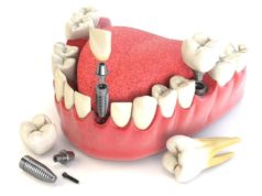 Протезирование зубов: современные технологии