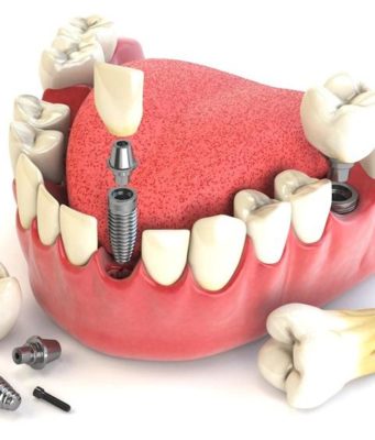 Протезирование зубов: современные технологии