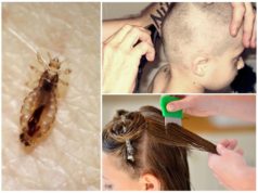 Что делать если заразился вшами