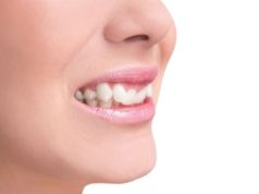 Исправление прикуса: способы, особенности