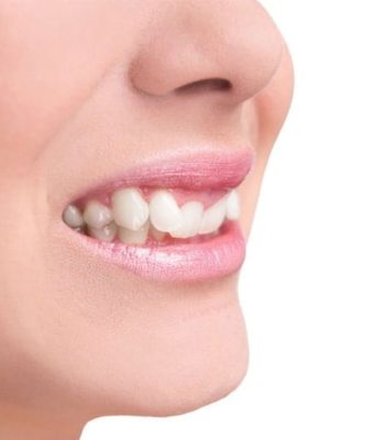 Исправление прикуса: способы, особенности