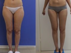 Липосакция: фото результатов ДО и ПОСЛЕ