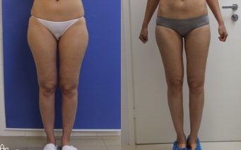 Липосакция: фото результатов ДО и ПОСЛЕ