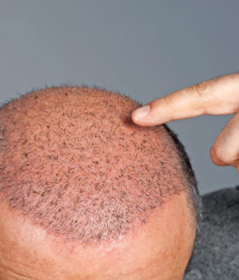 Трансплантация волос: все, что вы хотели узнать