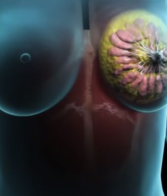 Преимущества лечения рака груди в Израиле