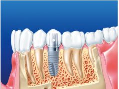 Почему необходима имплантация зубов?