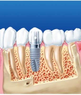 Почему необходима имплантация зубов?