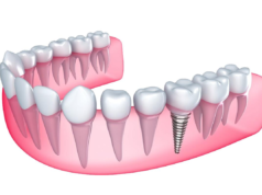 Обоснование выбора способа протезирования с опорой на имплантатах