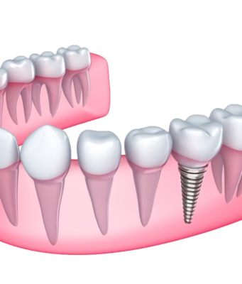 Обоснование выбора способа протезирования с опорой на имплантатах