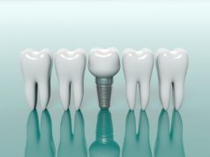 Как выполняется имплантация зубов в современных стоматологиях?