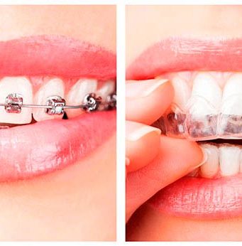 Как происходит исправление прикуса?