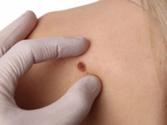 Меланома кожи: симптомы и лечение