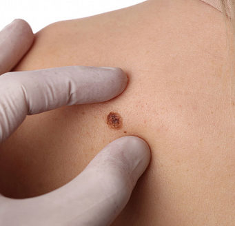 Меланома кожи: симптомы и лечение