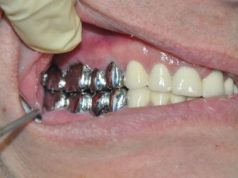 Показания для установки металлических коронок