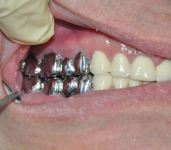 Показания для установки металлических коронок