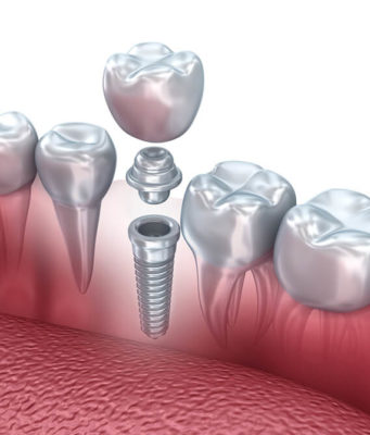 Основные этапы в имплантации зубов