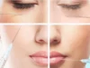 Контурная пластика гиалуроновой кислотой: особенности и эффект процедуры