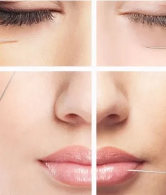 Контурная пластика гиалуроновой кислотой: особенности и эффект процедуры