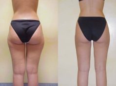 Показания для проведения липосакции