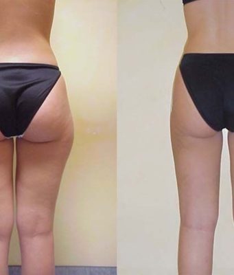 Показания для проведения липосакции