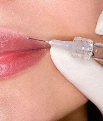 Чем сейчас накачивают губы?