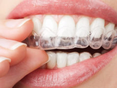 Капы для зубов в стоматологии